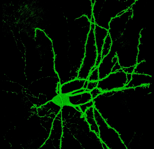 Transformer des cellules de peau en cellules cérébrales : une percée dans la recherche sur la maladie de Huntington ?