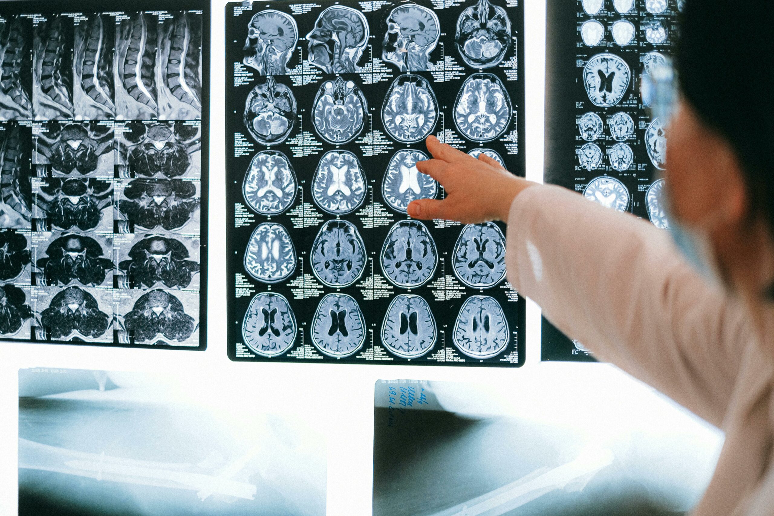 Prix HDBuzz 2025 : MR-« pourquoi » est-ce que je me sens comme ça ? Comment l’IRM nous aide à comprendre pourquoi les personnes atteintes de MH peuvent parfois ne pas avoir conscience de leurs symptômes